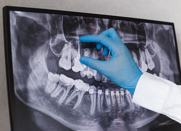 a closeup of a dental X-ray
