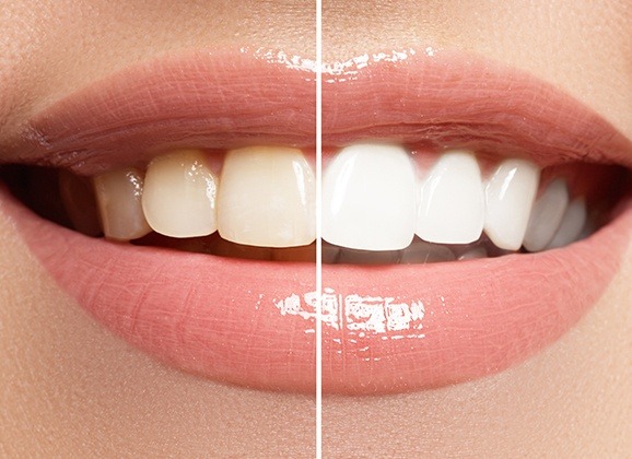 Smile before and after teeth whitening