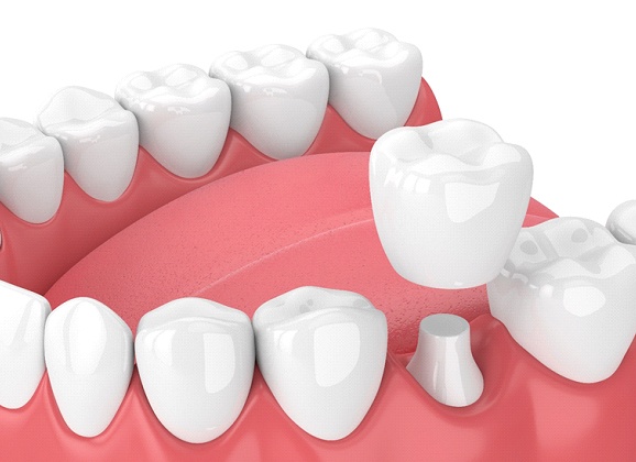 Diagram of dental crown in Brooklyn being placed