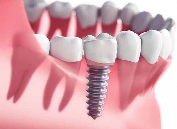 Animated dental implant supported dental crown