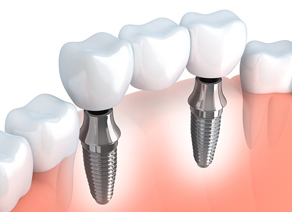 Animated dental implant supported fixed bridge