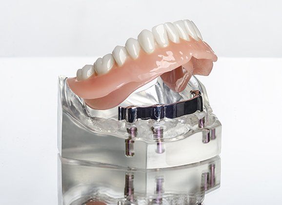 Model dental implant supported denture