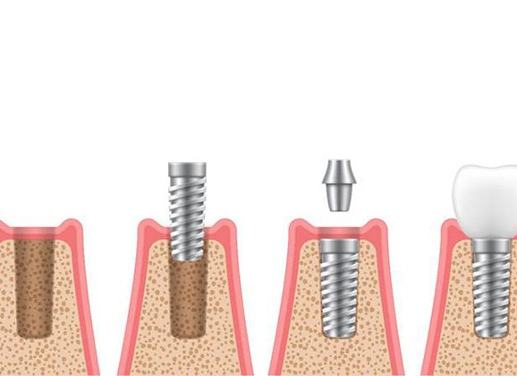 illustration of dental implant process