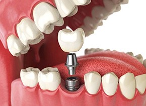 illustration of dental implant