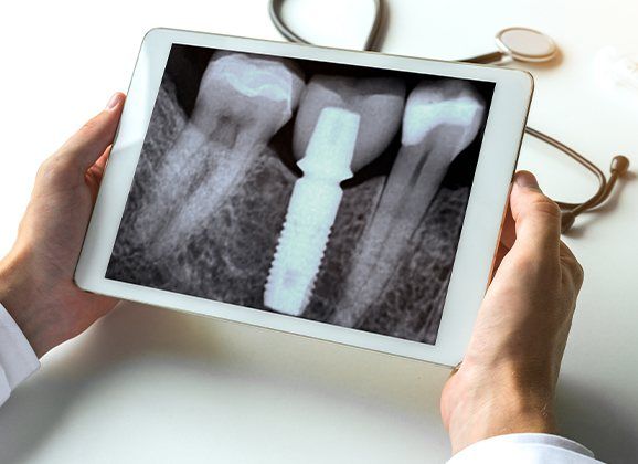 X-ray of dental implant supported replacement tooth