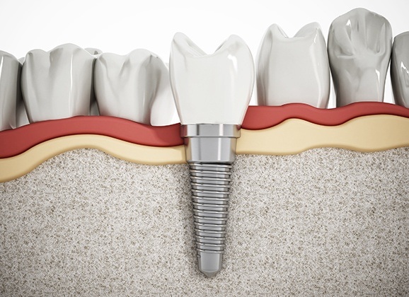 Animated dental implant supported replacement tooth