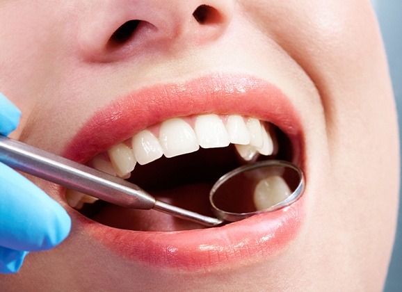 Closeup of smile after dental crown placement