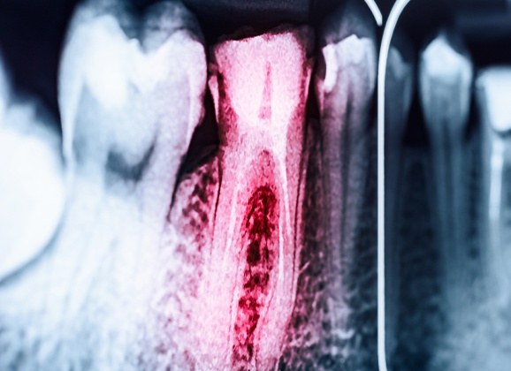 X-ray of tooth in need of root canal therapy