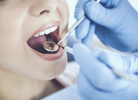 Closeup of a patient getting tooth-colored fillings in Brooklyn