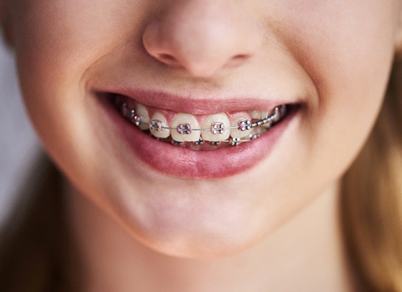 Traditional Braces Brooklyn, Orthodontics