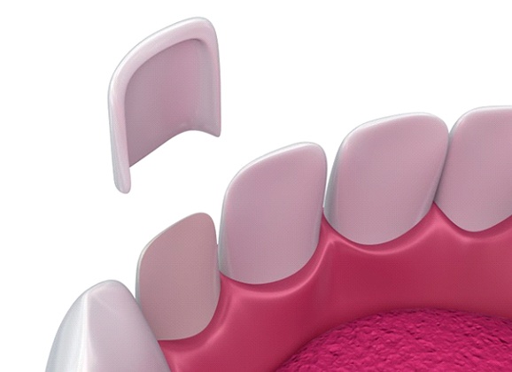 Diagram of porcelain veneers in Brooklyn