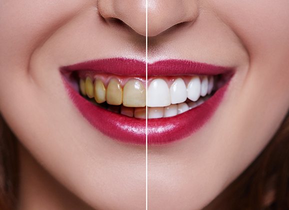 Smile closeup before and after visiting Brooklyn cosmetic dentist 
