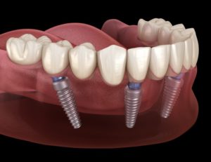 dentures secured with dental implants in Brooklyn 