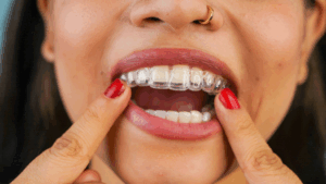 a close-up of an Invisalign aligner being removed