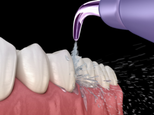 a 3D illustration showing how a water flosser works
